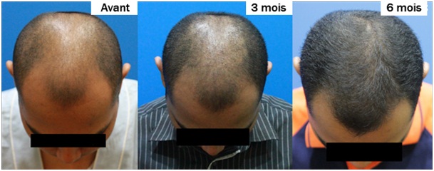 Le masque pour les bouts fouettés des cheveu avec lhuile dolive